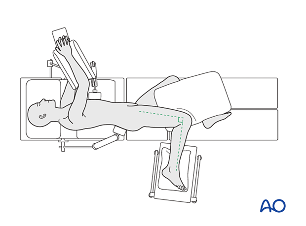 Patient in lateral position with knee flexion at 90° and hip extension