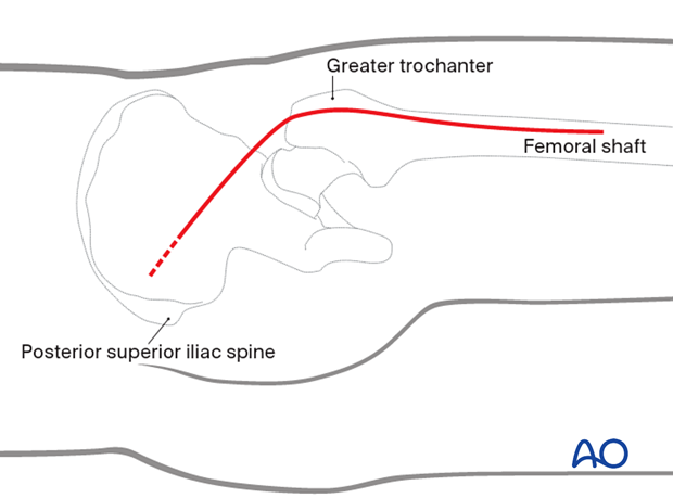 Kocher-Langenbeck approach – skin incision