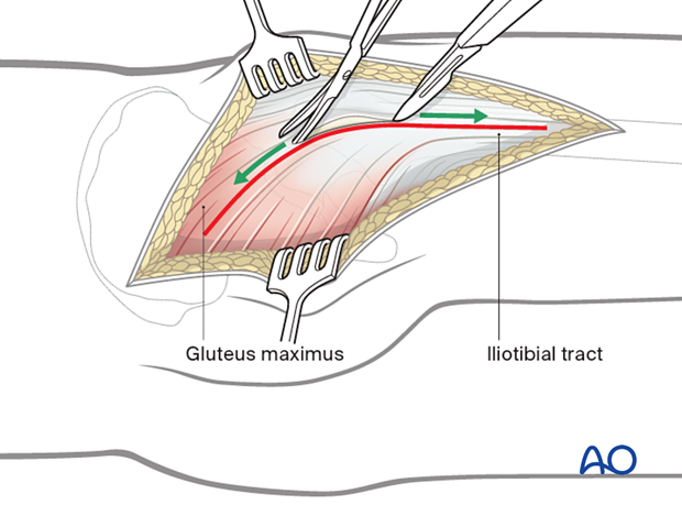 Kocher-Langenbeck approach – superficial surgical dissection