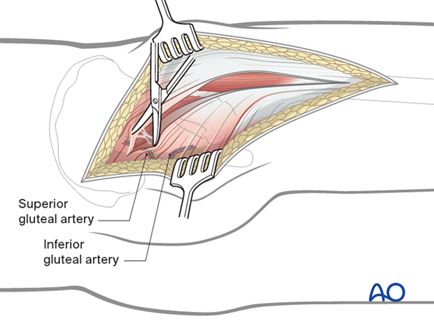 Kocher-Langenbeck approach - splitting the gluteus maximus