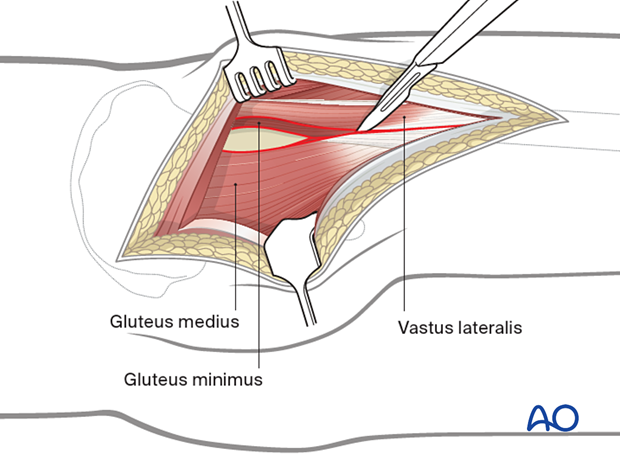 Kocher-Langenbeck approach - deep dissection
