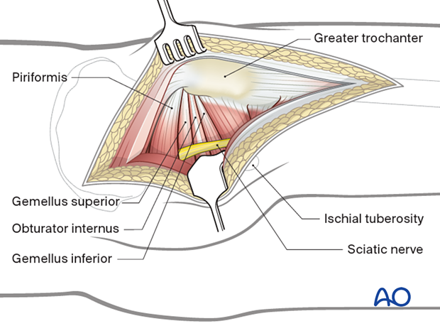 Kocher-Langenbeck approach - deep dissection