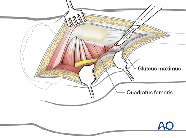 Kocher-Langenbeck approach - option: detach the gluteus maximus muscle