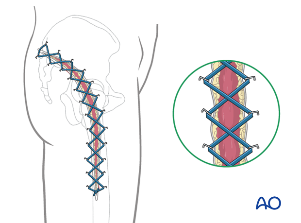 Gluteal compartment syndrome – use of elastic retention sutures