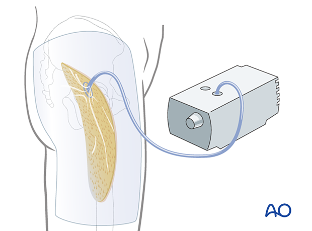 Gluteal compartment syndrome – use of a wound vacuum-assisted closure (VAC) device