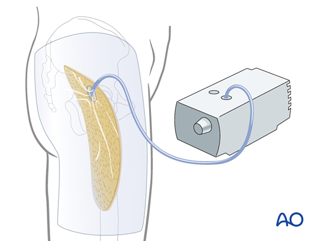 Gluteal compartment syndrome