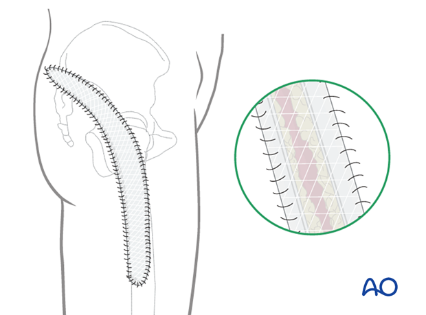 Gluteal compartment syndrome – delayed soft-tissue management: secondary coverage