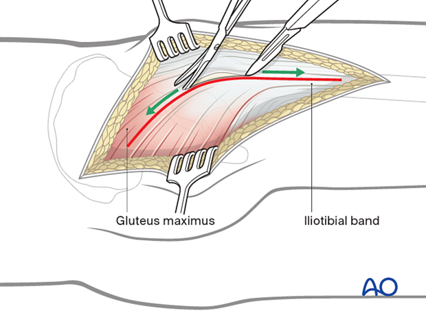 Kocher-Langenbeck approach – superficial surgical dissection
