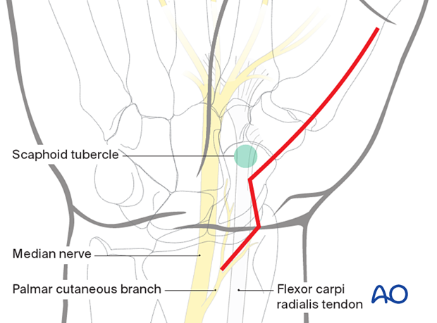 Extensile approach to the thenar compartment