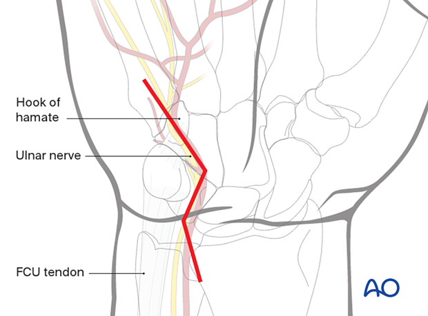 Extensile approach to the hypothenar compartment