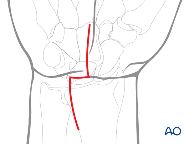 Extensile approach to the palmar compartment