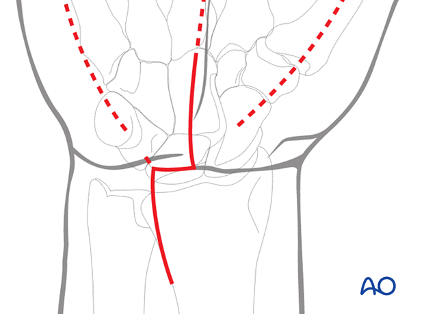 Compartment syndrome of the hand - separate incisions over each of the compartments may be needed.