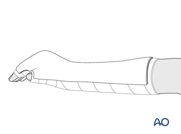 70 X010 Compartment syndrome hand