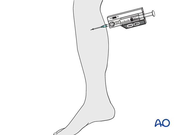 Compartment syndrome in the leg - intracompartmental pressure measurement