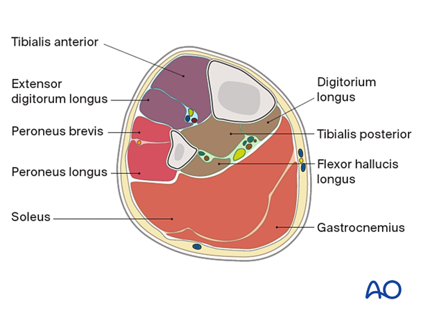 Compartment syndrome in the leg - muscular anatomy