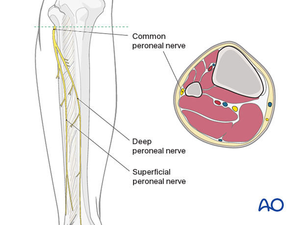 Compartment syndrome in the leg - neurovascular anatomy