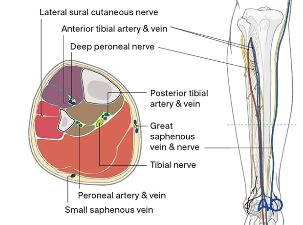 Compartment syndrome in the leg - neurovascular anatomy