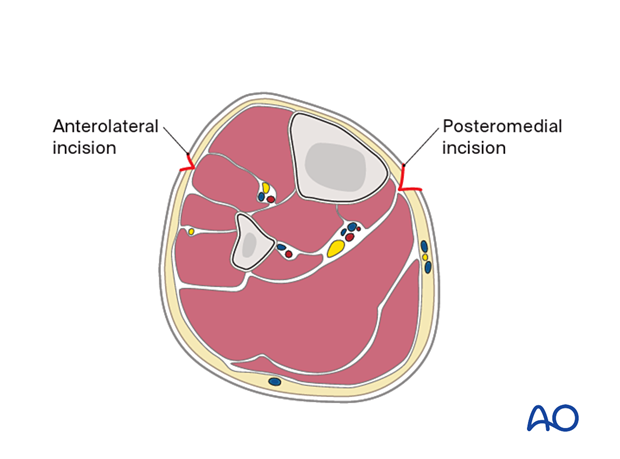 Compartment syndrome in the leg - dual-incision technique