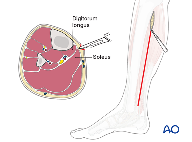 Compartment syndrome in the leg - posteromedial incision
