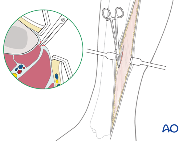 Compartment syndrome in the leg - posteromedial incision