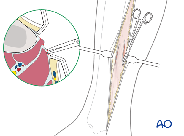 Compartment syndrome in the leg - posteromedial incision