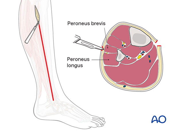 Compartment syndrome in the leg - anterolateral incision