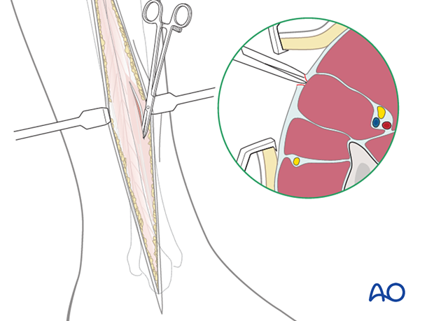 Compartment syndrome in the leg - anterolateral incision