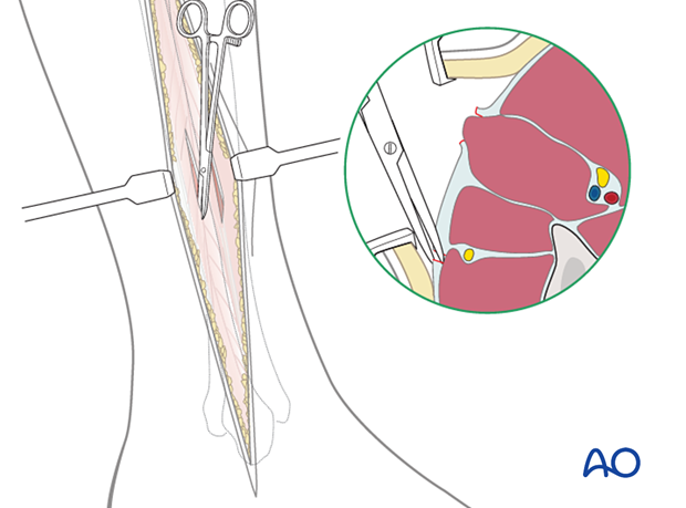 Compartment syndrome in the leg - anterolateral incision
