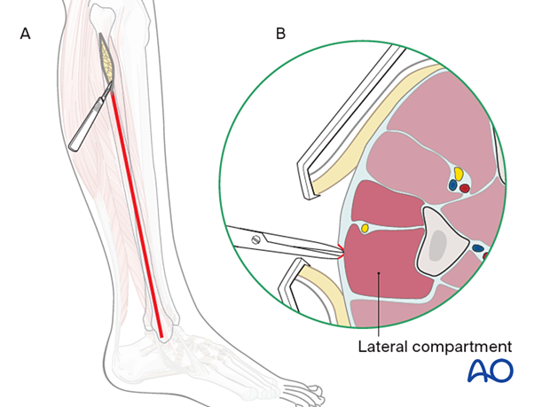 Compartment syndrome in the leg - single-incision, parafibular four-compartment fasciotomy