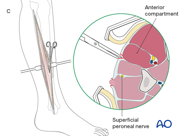 Compartment syndrome in the leg - single-incision, parafibular four-compartment fasciotomy