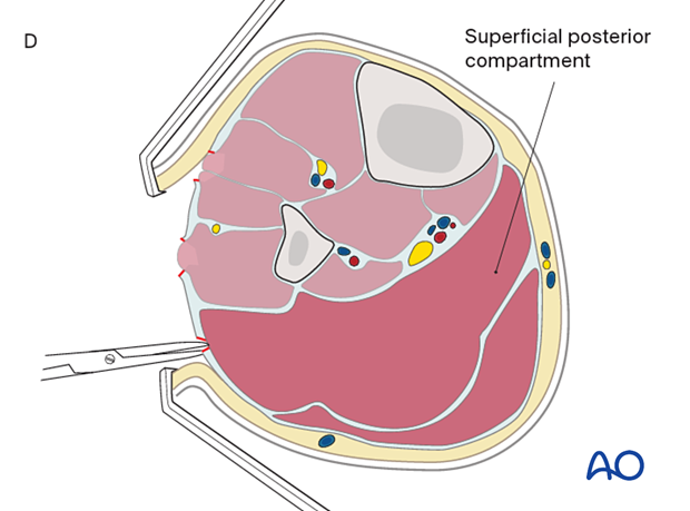 Compartment syndrome in the leg - single-incision, parafibular four-compartment fasciotomy