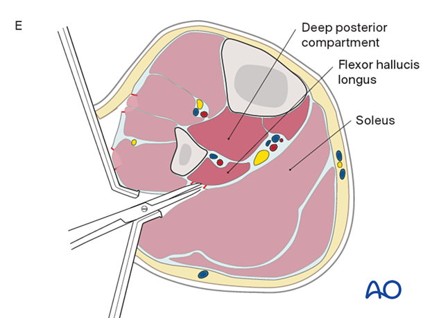 Compartment syndrome in the leg - single-incision, parafibular four-compartment fasciotomy