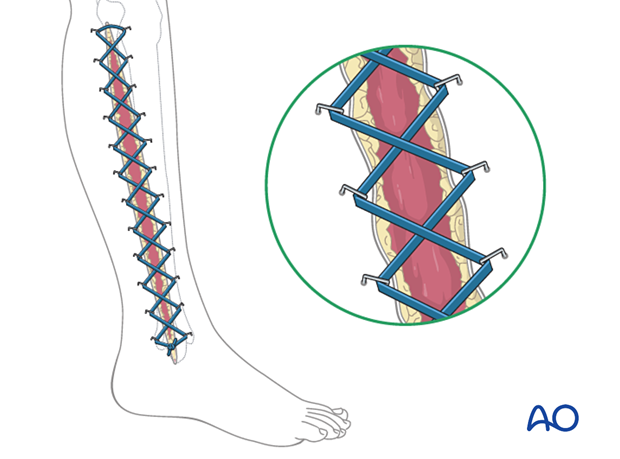 Compartment syndrome in the leg - temporary soft-tissue management
