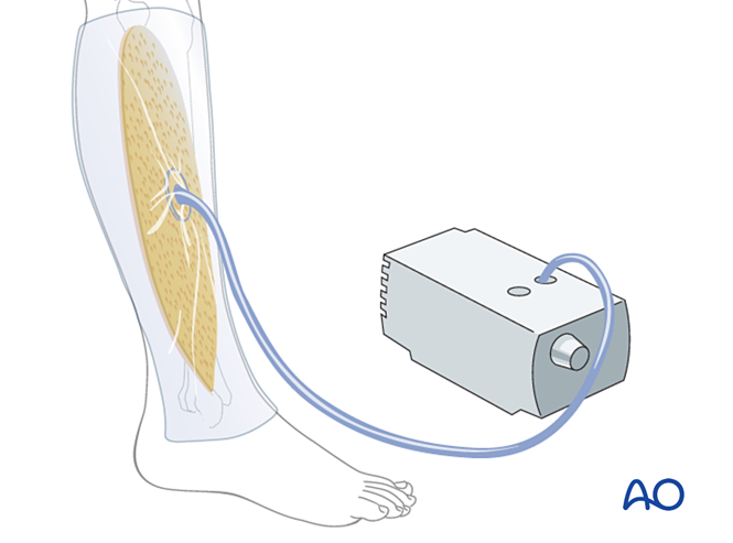 Compartment syndrome in the leg