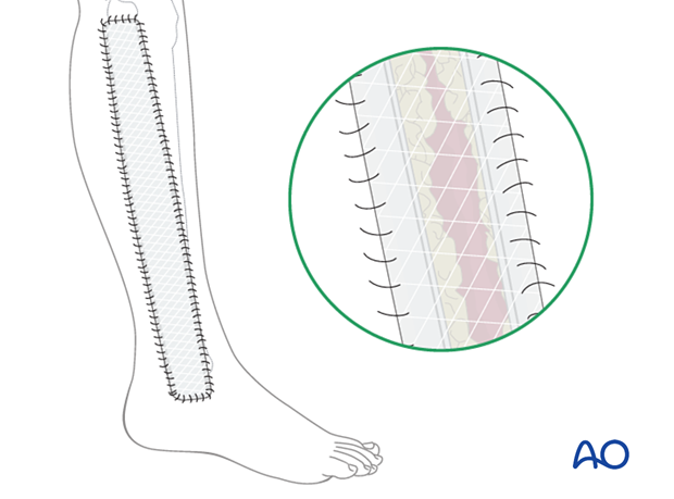 Compartment syndrome in the leg - delayed soft-tissue management: secondary coverage