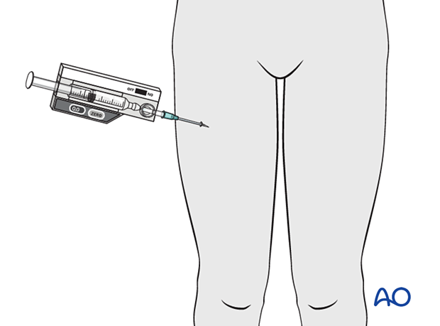 Compartment syndrome in the thigh - intracompartmental pressure measurement