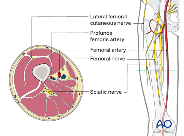 Compartment syndrome in the thigh – compartmental anatomy