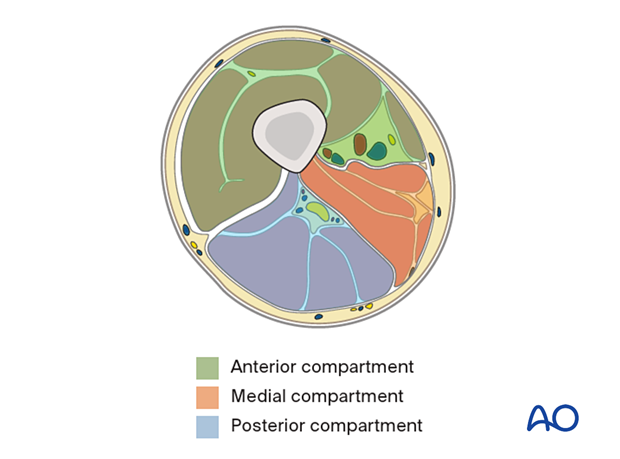 Compartment syndrome in the thigh – the compartments
