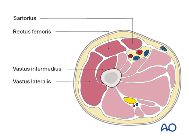 Proximal femur – anterior compartment