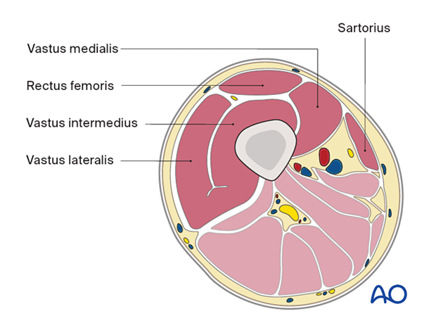 Mid femur – anterior compartment 