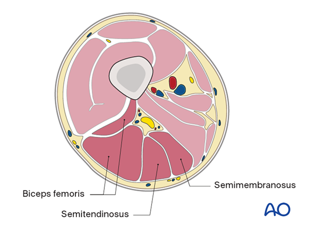 Mid femur – posterior compartment