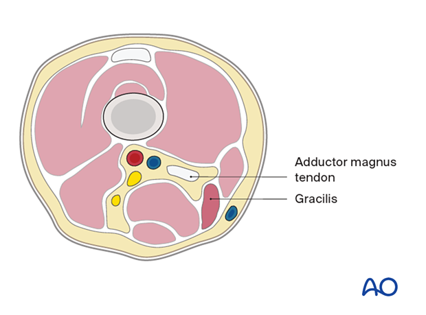 Distal femur – medial compartment