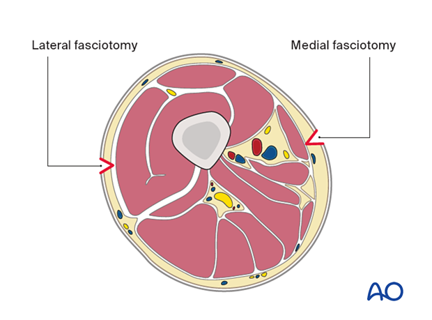 Compartment syndrome in the thigh – lateral and medial fasciotomies