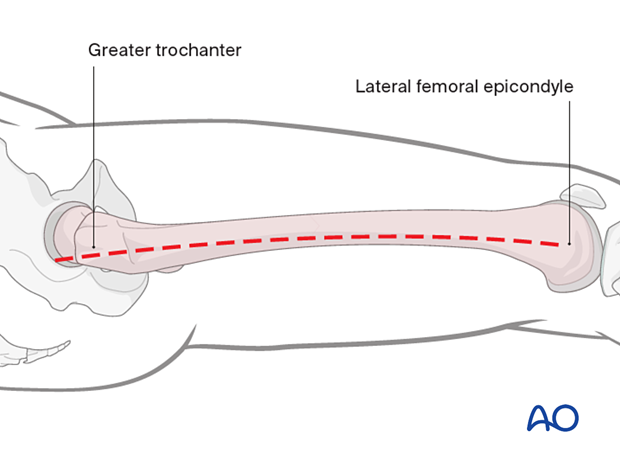Lateral approach to femoral shaft – skin incision