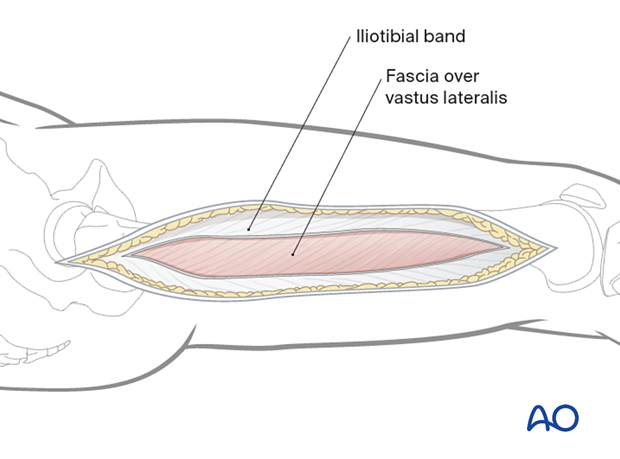 Lateral approach to femoral shaft – Opening the fascia lata