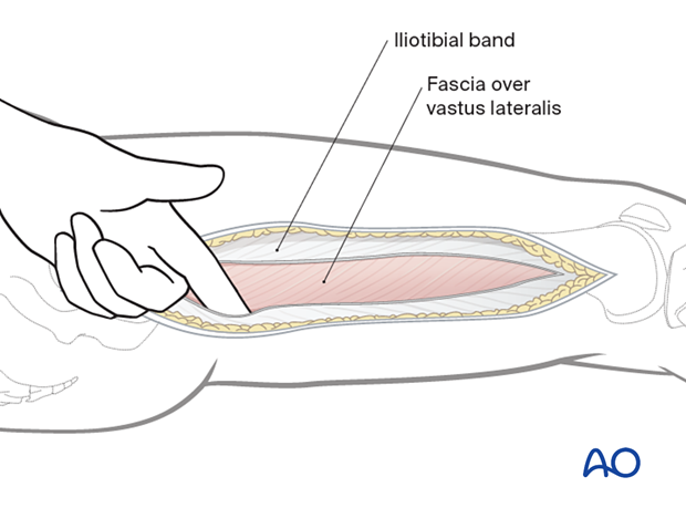 Lateral approach to femoral shaft – separation of vastus lateralis from Iliotibial band