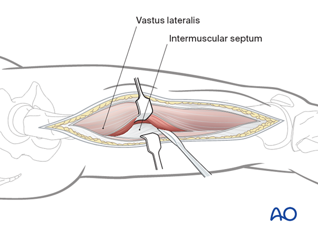Lateral approach to femoral shaft – Mobilization of vastus lateralis