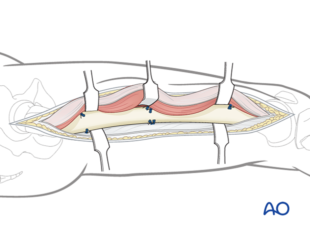 Lateral approach to femoral shaft – Exposure of femoral shaft