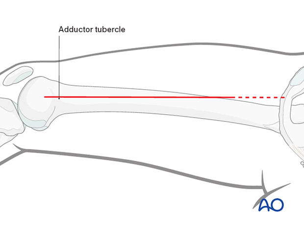 Skin incision made in the line of the tendon of adductor magnus