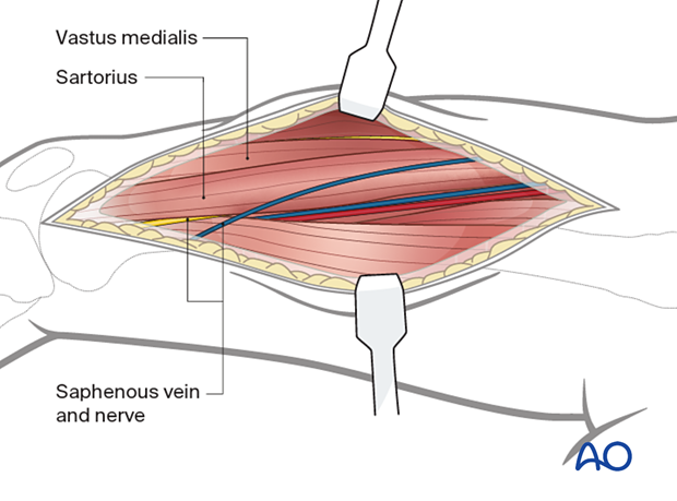 Identifying the vastus medialis and sartorius